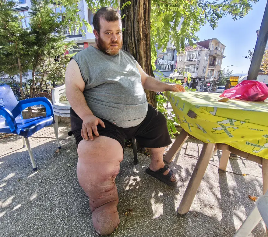Fil hastası Kazım'ın tek dileği yürüyebilmek. 172 kilodan 90 kiloya düşmesi gerekiyor 1