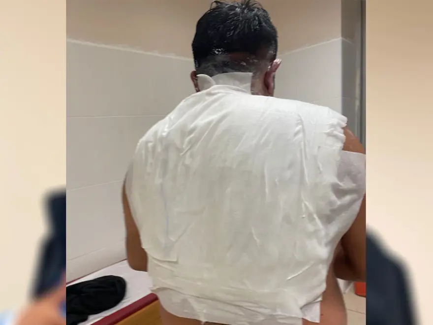 SICAK SU VÜCUDUNA DÖKÜLDÜ 3