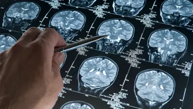 Japonya'da, Alzheimer belirtilerini saptayabilen kan testi kiti onaylandı