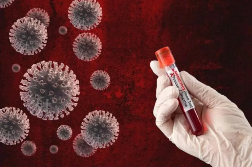 11 soruda maymun çiçeği rehberi: Maymun çiçeği nedir, belirtileri nelerdir? Maymun çiçeği nasıl bulaşır, ne zaman test yaptırılmalı? 