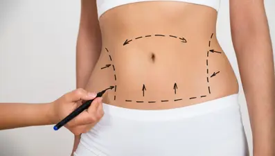 Doktor uyarısı: Liposuction bir zayıflama yöntemi değildir (Vücut şekillendirme amacı ile yapılmalı)