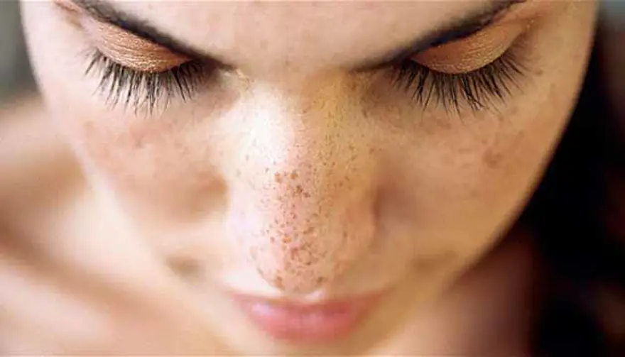 Güneş lekelerine karşı 5 etkili çözüm 7