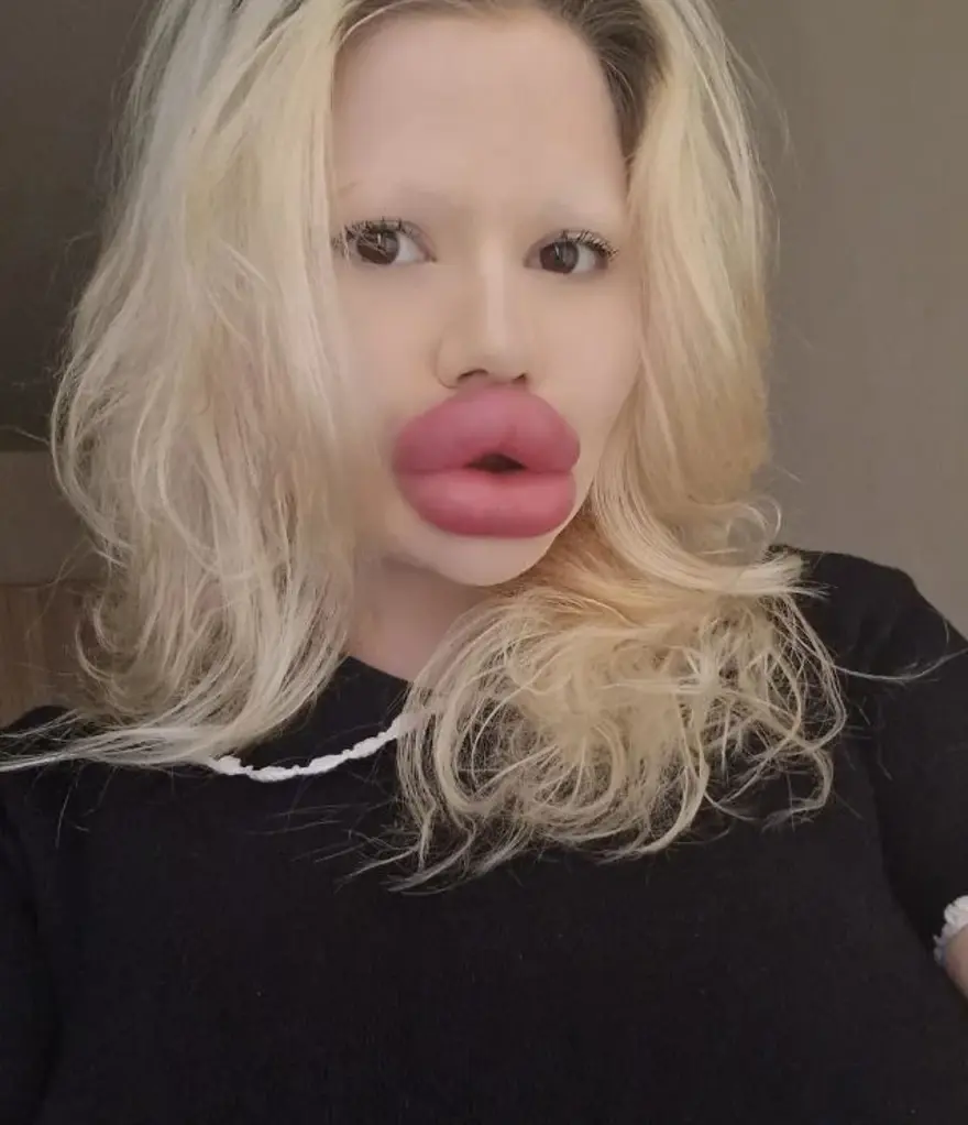 Dünyanın en büyük dudaklı kadını: Sağlık çalışanları onu tedavi etmeyi reddediyor 1