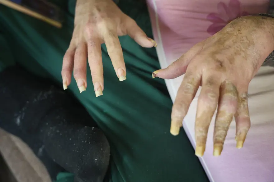 3 yıldır evden dışarı adım atmadı: "Banyo da yapmak istemiyorum, elimde olsa tuvalete gitmem" 1 3 yıldır evden dışarı adım atmadı: "Banyo da yapmak istemiyorum, elimde olsa tuvalete gitmem" 1