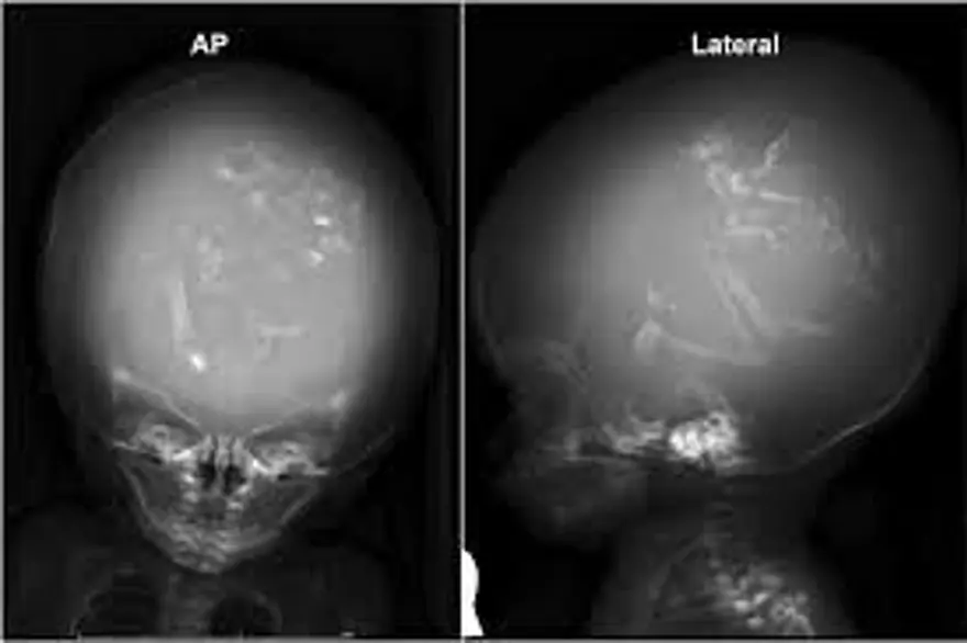 Bir yaşındaki kız çocuğunun beyninden doğmamış ikizi çıkarıldı 2
