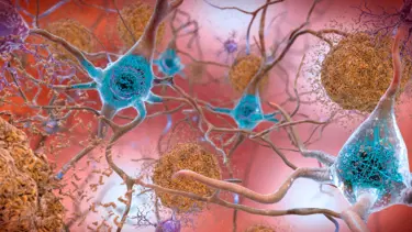 Araştırmacılardan Alzheimer'a karşı yeni yöntem: SHIELD nedir?