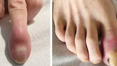 Akciğer kanserine yakalandı: Parmakları bu hale geldi