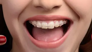 Diş teli temizliği nasıl yapılır?