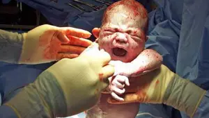 Küba anneden bebeğe HIV geçişini önlemeyi başardı