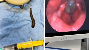 Çorum'da bir hastanın boğazından canlı sülük çıkarıldı
