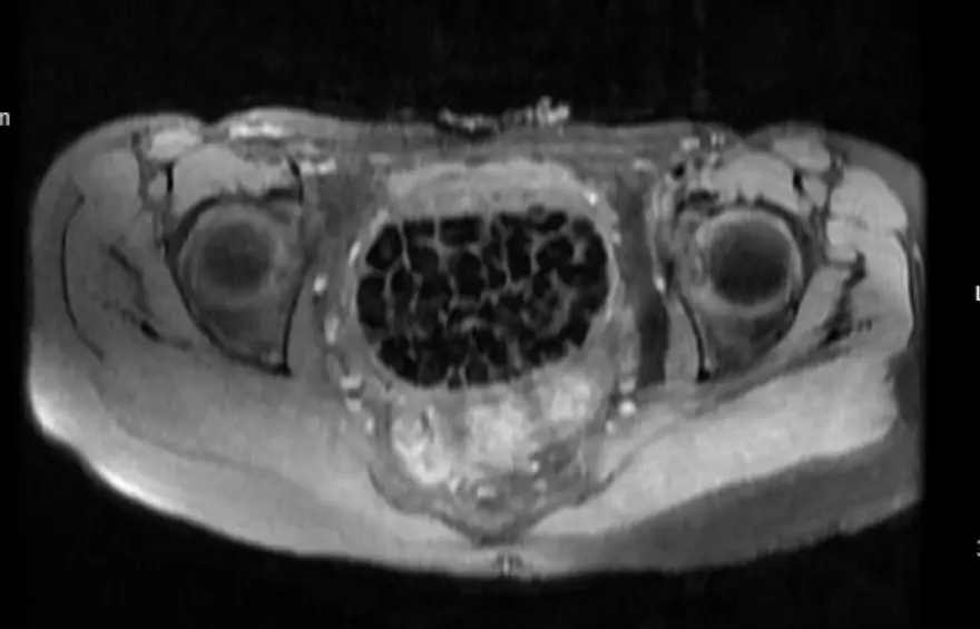 Doktorlar bile şaşırdı: Genç kızın vücudundan 287 adet taş çıkarıldı 1