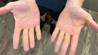 8 ay boyunca sadece et, tereyağı ve peynir yiyen adam soluğu hastanede aldı: Yan etkileri inanılmaz