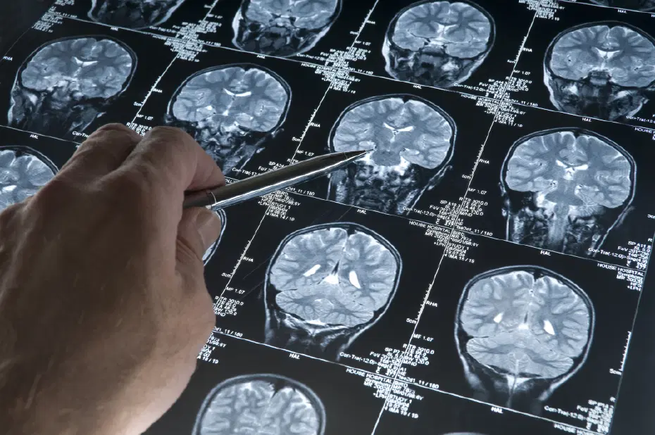 Alzheimer’da gençlik proteini keşfi
