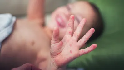 DSÖ'den uyarı: Kızamık son 23 yılın en yüksek seviyesinde