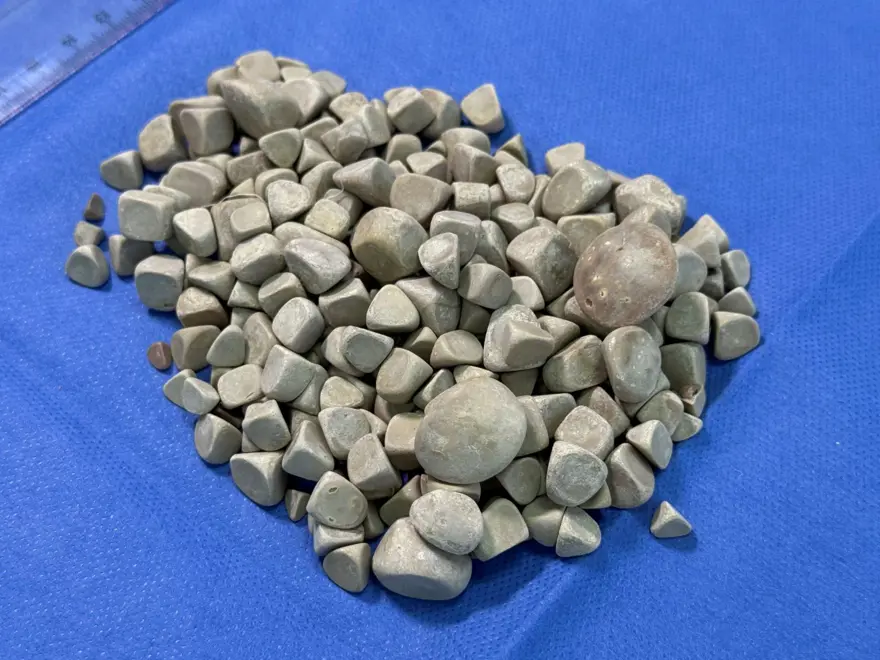 Doktorlar bile şaşırdı: Genç kızın vücudundan 287 adet taş çıkarıldı 2