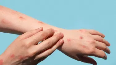 Almanya'da yeni M-çiçeği virüsü varyantı