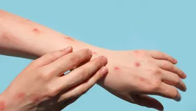 Almanya'da yeni M-çiçeği virüsü varyantı