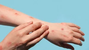 Almanya'da yeni M-çiçeği virüsü varyantı Almanya'da yeni M-çiçeği virüsü varyantı