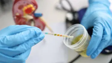 Hematüri nedir? Nedenleri ve belirtileri nelerdir? Hematuri nasıl tedavi edilir?