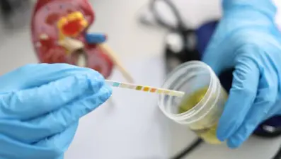 Hematüri nedir? Nedenleri ve belirtileri nelerdir? Hematuri nasıl tedavi edilir?