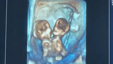 Bir annenin en zor seçimi: Yapışık ikizler doğuracağını öğrendi