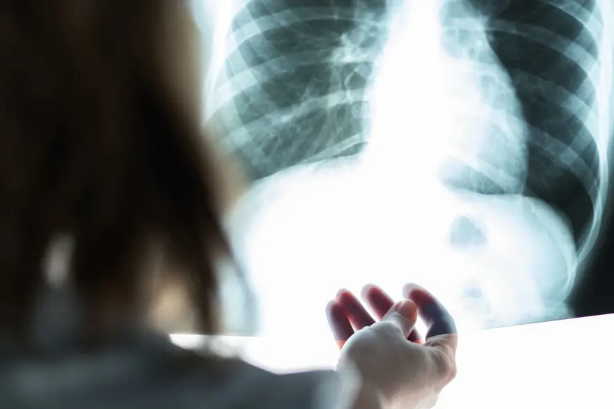 ÖLÜMCÜL AKCİĞER PIHTISI GELİŞTİRME RİSKİ 3 KAT ARTTI 5