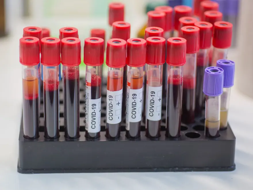 Bilim insanları uyardı: Covid-19'a yakalanılan ilk bir ay içinde ölümcül kan pıhtısı geliştirme riski 33 kat artıyor 7