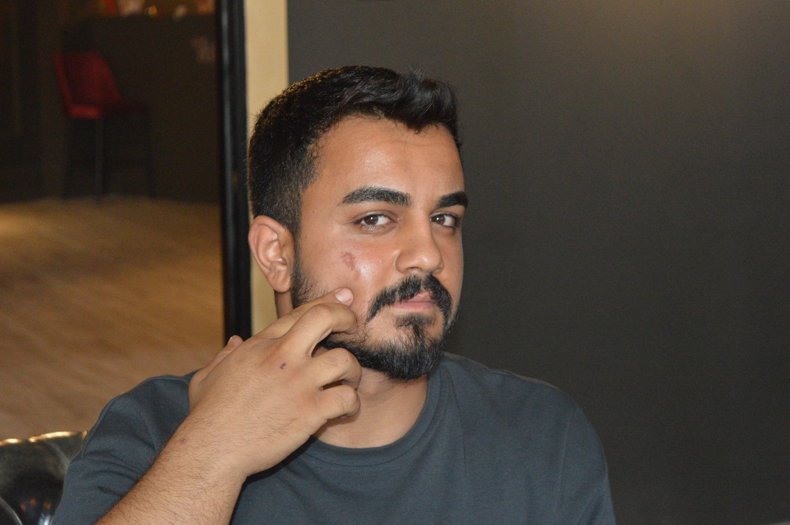 Lazer epilasyona gitti, yüzü yandı