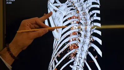 Sinir dokusu mühendisliği hastalara umut olacak