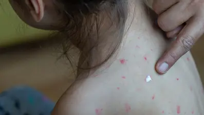 Uzmanlar uyardı: Yaygın hastalık körlüğe neden olabilir, belirtileri soğuk algınlığıyla karıştırılıyor