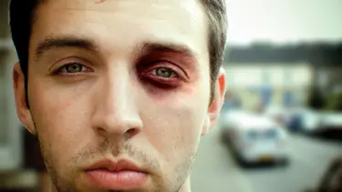 Göz çukuru kırığı nasıl tedavi edilir?