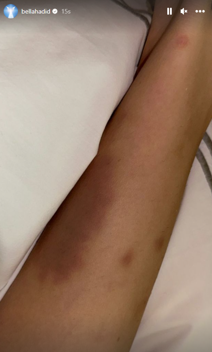 Bella Hadid hastane paylaşımıyla endişe uyandırdı 2