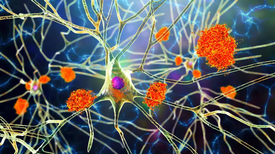 Alzheimer hastaları için gerçek bir tedavi sunan ilk ilaç: Lecanemab nedir? Lecanemab'ın yan etkileri nelerdir? 3 Alzheimer hastaları için gerçek bir tedavi sunan ilk ilaç: Lecanemab nedir? Lecanemab'ın yan etkileri nelerdir? 3