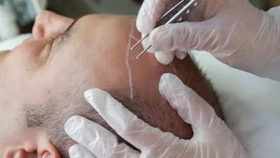 Saç ekimi nedir, nasıl yapılır? (Saç ekimi kimlere uygundur?)