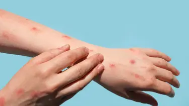 Çiçek hastalığı nedir? Çiçek hastalığının belirtileri nelerdir?