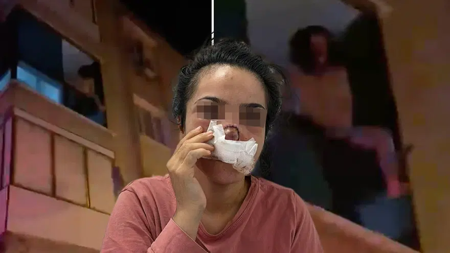 Burnu koparılan kadın dehşet anlarını anlattı: Bir anda boynuma sarılıp ısırdı Burnu koparılan kadın dehşet anlarını anlattı: Bir anda boynuma sarılıp ısırdı