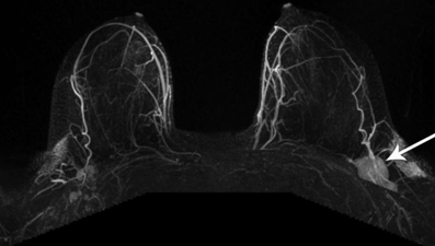 Corona virüs aşısının ardından bazı kadınların göğsünde şişkinlik oluşuyor
