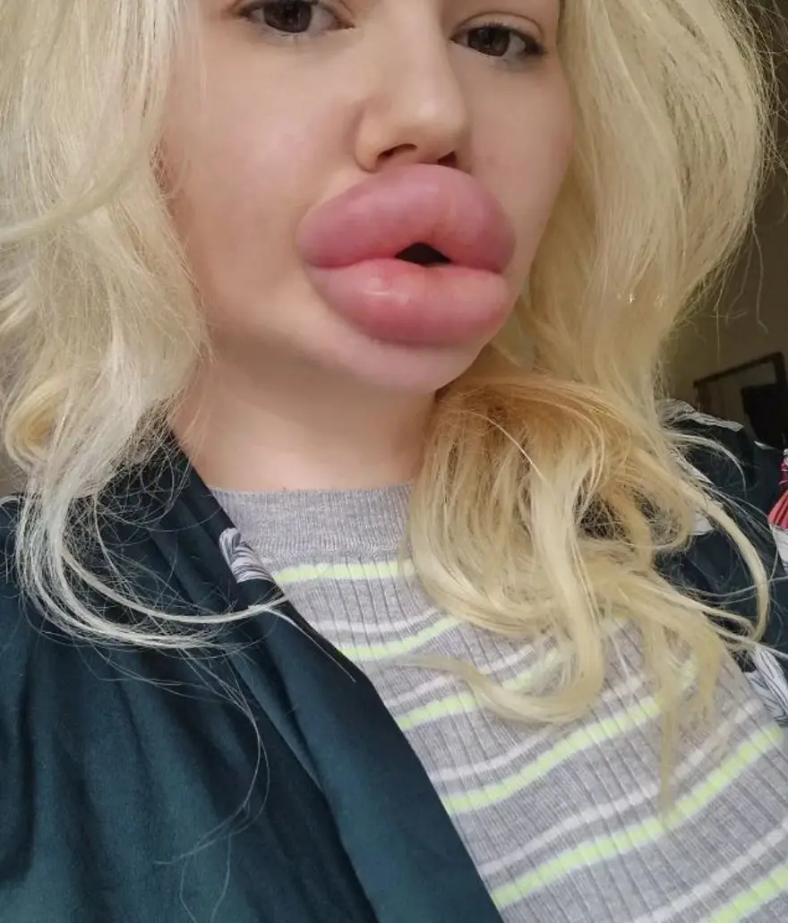 Dünyanın en büyük dudaklı kadını: Sağlık çalışanları onu tedavi etmeyi reddediyor 3