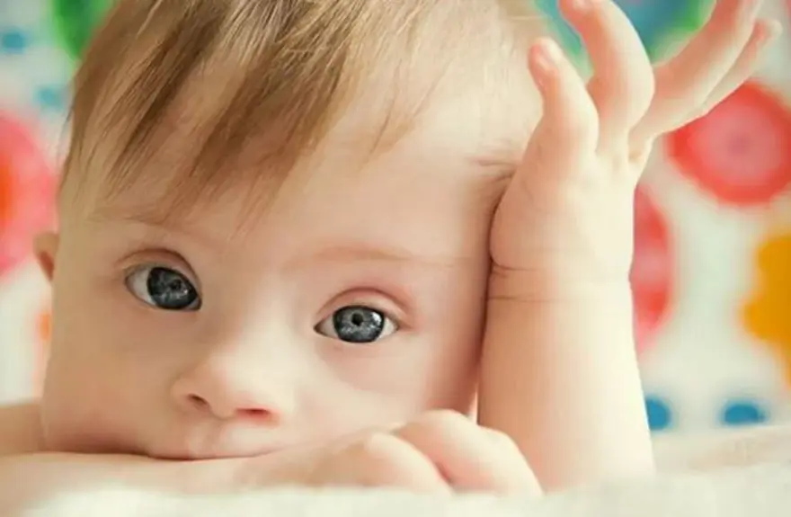 DOWN SENDROMU NEDİR? 1 DOWN SENDROMU NEDİR? 1