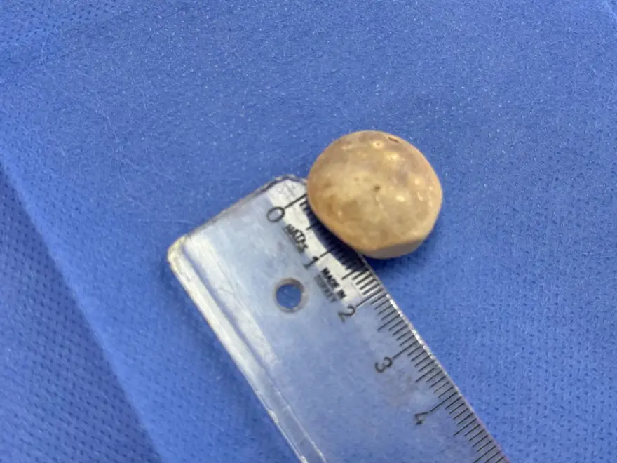 Doktorlar bile şaşırdı: Genç kızın vücudundan 287 adet taş çıkarıldı 5