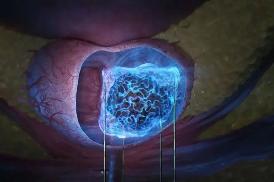 Tıbbi ve Sağlık Teknolojisi – AngioDynamics NanoKnife 17 Tıbbi ve Sağlık Teknolojisi – AngioDynamics NanoKnife 17