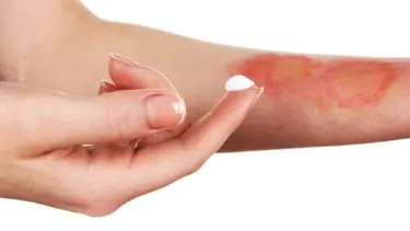 Yanık izine ne iyi gelir? Yanık izi nasıl düzelir, nasıl geçer?