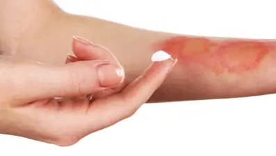 Yanık izine ne iyi gelir? Yanık izi nasıl düzelir, nasıl geçer?