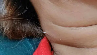 Yuttuğu balık kılçığı boynundan çıktı