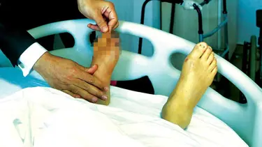 'Diyabetik Ayak' raporu yayımlandı