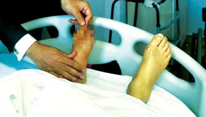 'Diyabetik Ayak' raporu yayımlandı 'Diyabetik Ayak' raporu yayımlandı