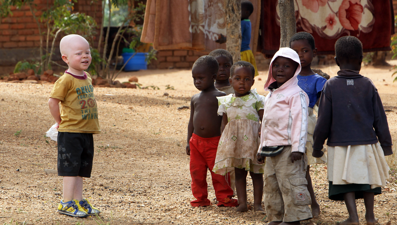 Afrika'nın dışlanan insanları: Albinolar (13 Haziran Dünya Albinizm Farkındalık Günü)