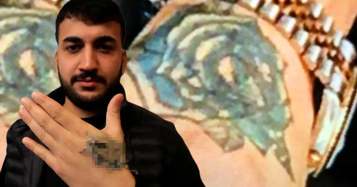 Dövmesini sildirmek istedi, elinden oluyordu