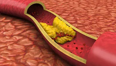 Kan pıhtılaşması nedir? Kan pıhtılaşması neden olur?