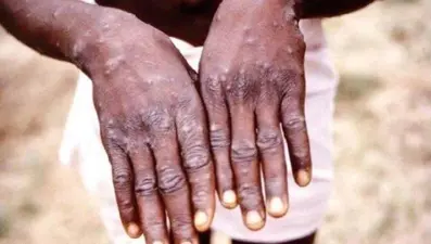 Namibya'da ilk M Çiçeği vakası tespit edildi